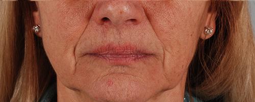 Juvederm Patient 174