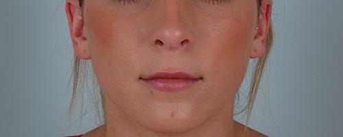 Juvederm Patient 175