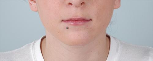 Juvederm Patient 175