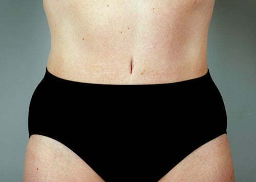 Tummy Tuck Patient 110