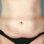 abdominoplasty-01a-before