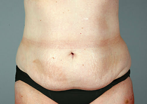 Tummy Tuck Patient 110