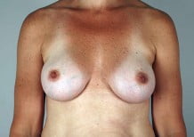 Breast Augmentation Patient 110