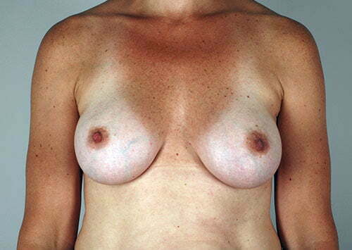 breast-augmentation-01a-after