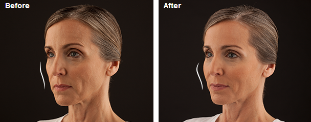 JUVÉDERM VOLUMA™ XC before and after photo showing increased volume in the cheeks.