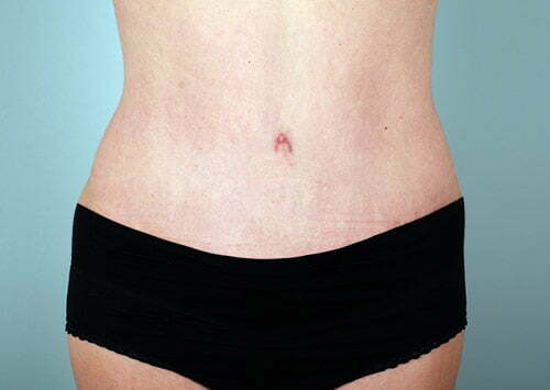 Tummy Tuck Patient 2182