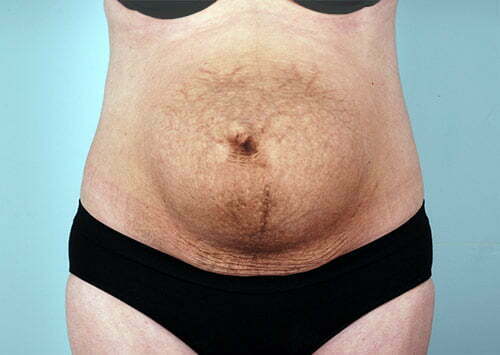 abdominoplasty-2182a-before
