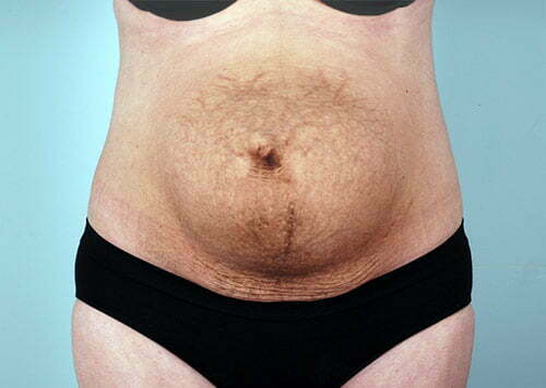 Tummy Tuck Patient 2182