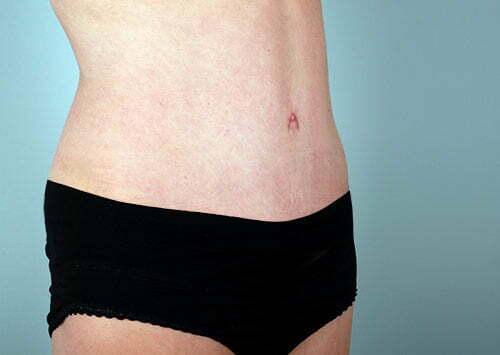 abdominoplasty-2182b-after