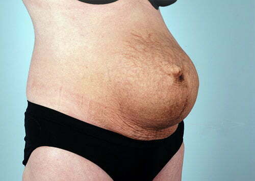 abdominoplasty-2182b-before