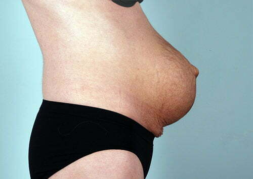 abdominoplasty-2182c-before