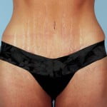 abdominoplasty-2189a-after