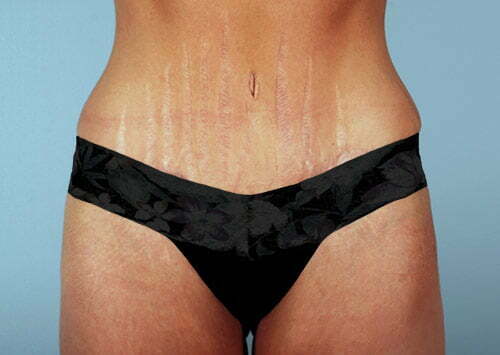 abdominoplasty-2189a-after