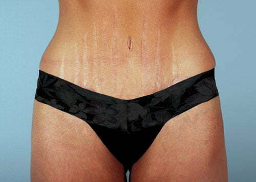 Tummy Tuck Patient 2189