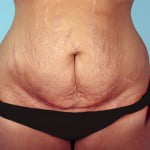 abdominoplasty-2189a-before