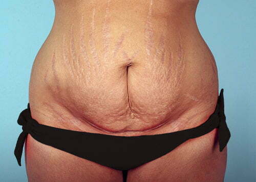 Tummy Tuck Patient 2189
