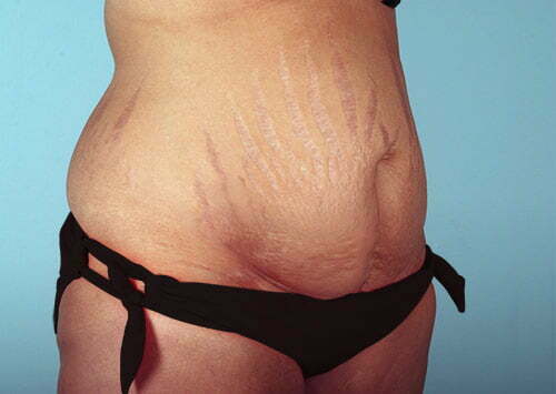 abdominoplasty-2189b-before