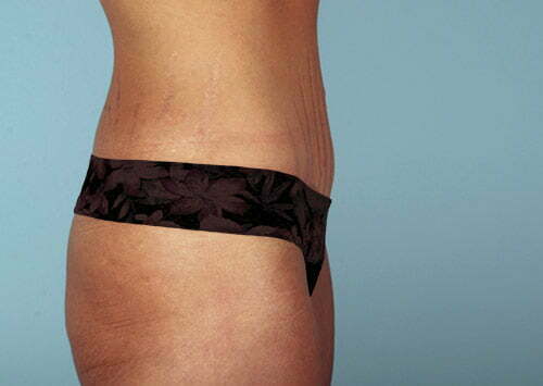 abdominoplasty-2189c-after