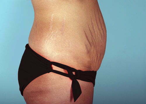 abdominoplasty-2189c-before