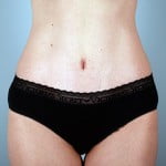 abdominoplasty-2196a-after