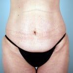 abdominoplasty-2196a-before