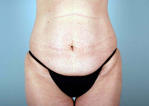 Tummy Tuck Patient 2196