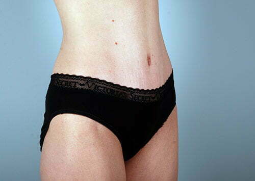 abdominoplasty-2196b-after