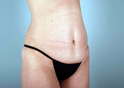 abdominoplasty-2196b-before