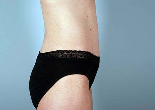 abdominoplasty-2196c-after