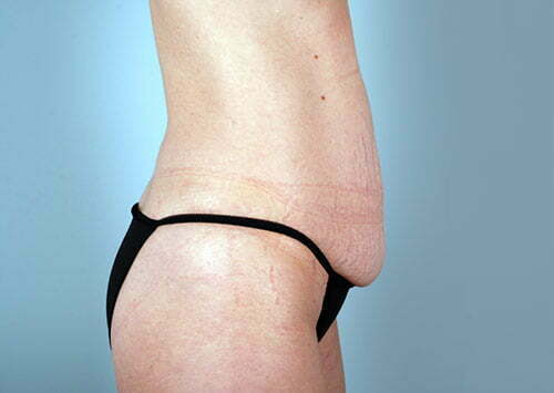 abdominoplasty-2196c-before