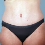 abdominoplasty-2203a-after