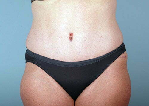 Tummy Tuck Patient 2203
