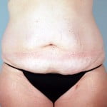 abdominoplasty-2203a-before