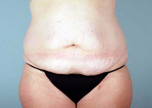 Tummy Tuck Patient 2203