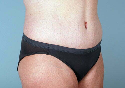 abdominoplasty-2203b-after