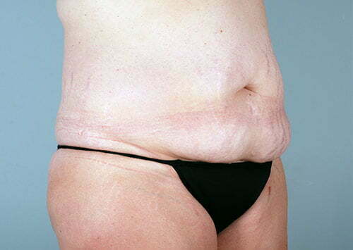 abdominoplasty-2203b-before