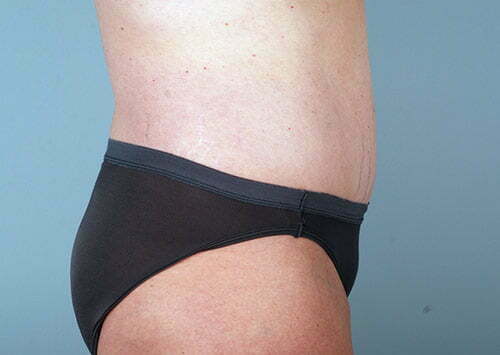 abdominoplasty-2203c-after