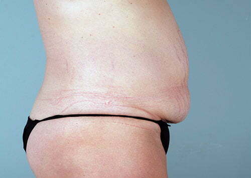 abdominoplasty-2203c-before