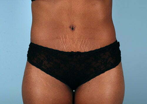 Tummy Tuck Patient 2211