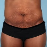 abdominoplasty-2211a-before