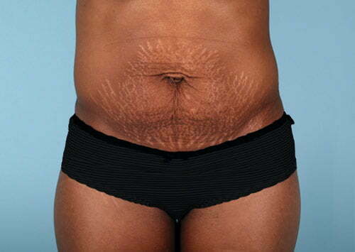 Tummy Tuck Patient 2211
