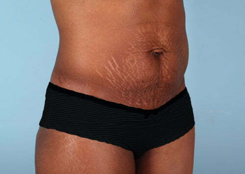 abdominoplasty-2211b-before