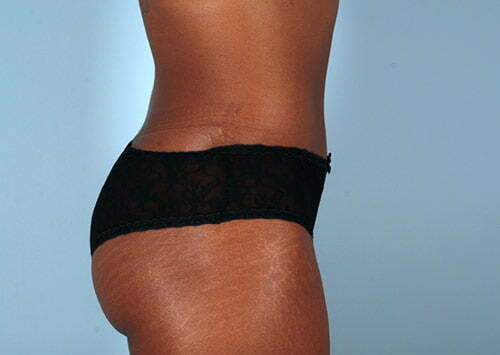 abdominoplasty-2211c-after