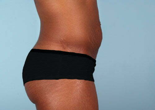 abdominoplasty-2211c-before