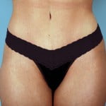 abdominoplasty-2218a-after