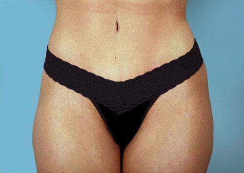 Tummy Tuck Patient 2218