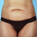 abdominoplasty-2218a-before