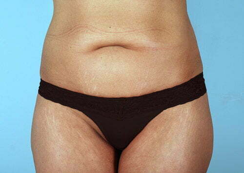 Tummy Tuck Patient 2218