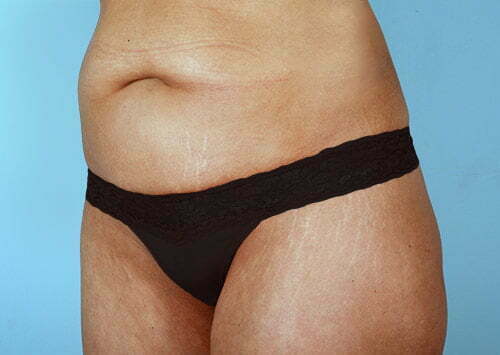 abdominoplasty-2218b-before