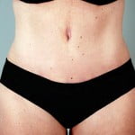 abdominoplasty-2223a-after